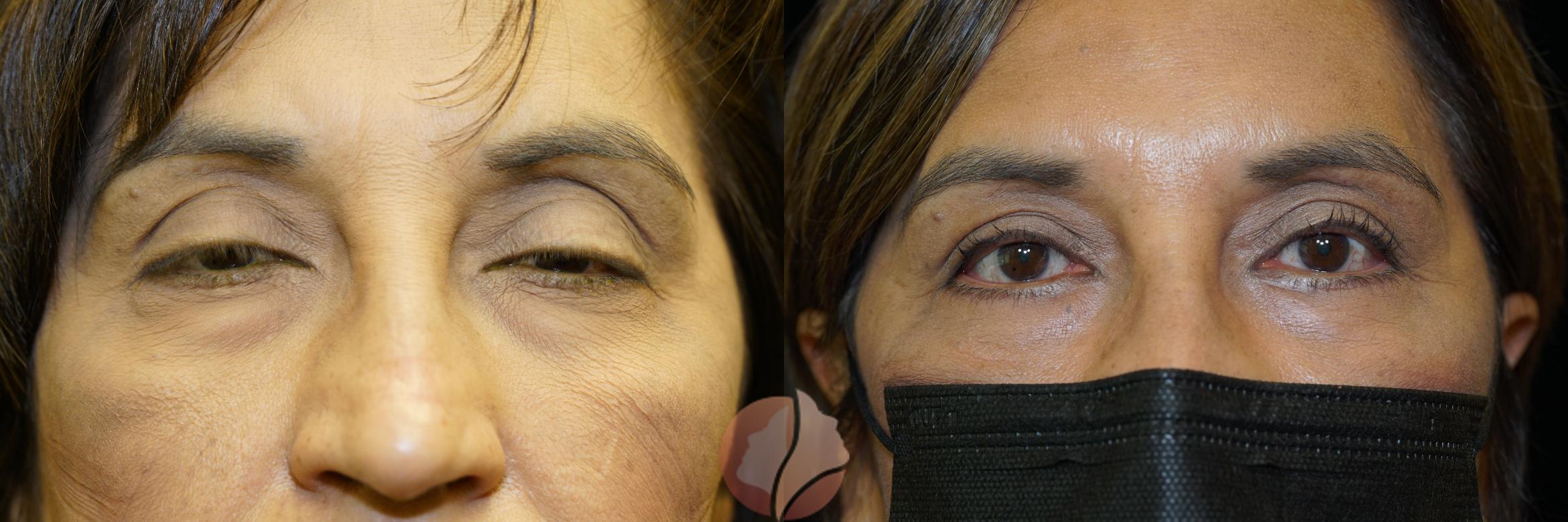 Before & After Lower Blepharoplasty Case 52 Front View in Saratoga, CA