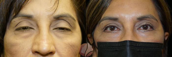 Before & After Ptosis - Women 60's Case 52 Front View in Saratoga, CA