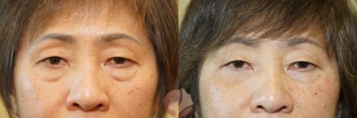 Before & After Lower Blepharoplasty Case 53 Front View in Saratoga, CA