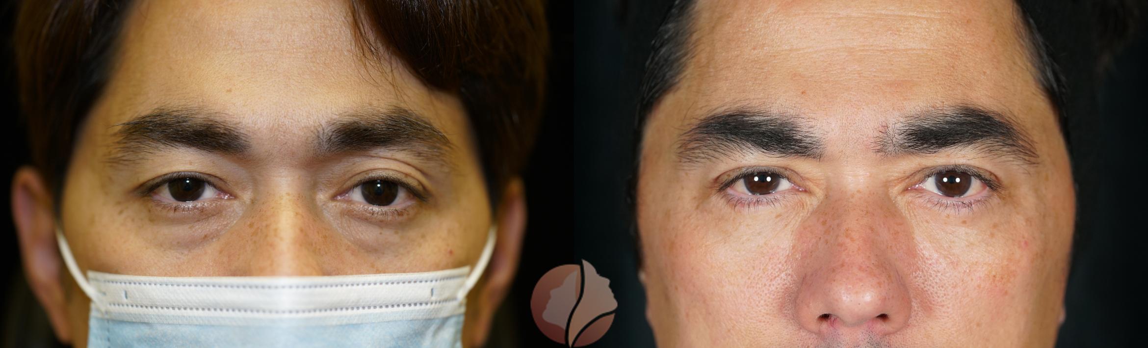 Before & After Lower Blepharoplasty Case 76 Front View in Saratoga, CA