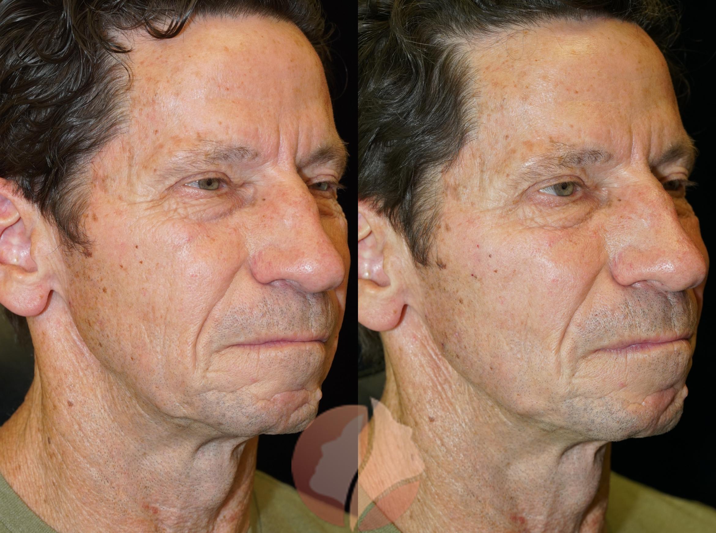 Before & After PDO Thread Lift Case 9 Right Oblique View in Saratoga, CA