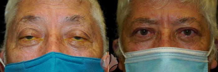 Before & After Ptosis - Men 60's Case 18 Front View in Saratoga, CA