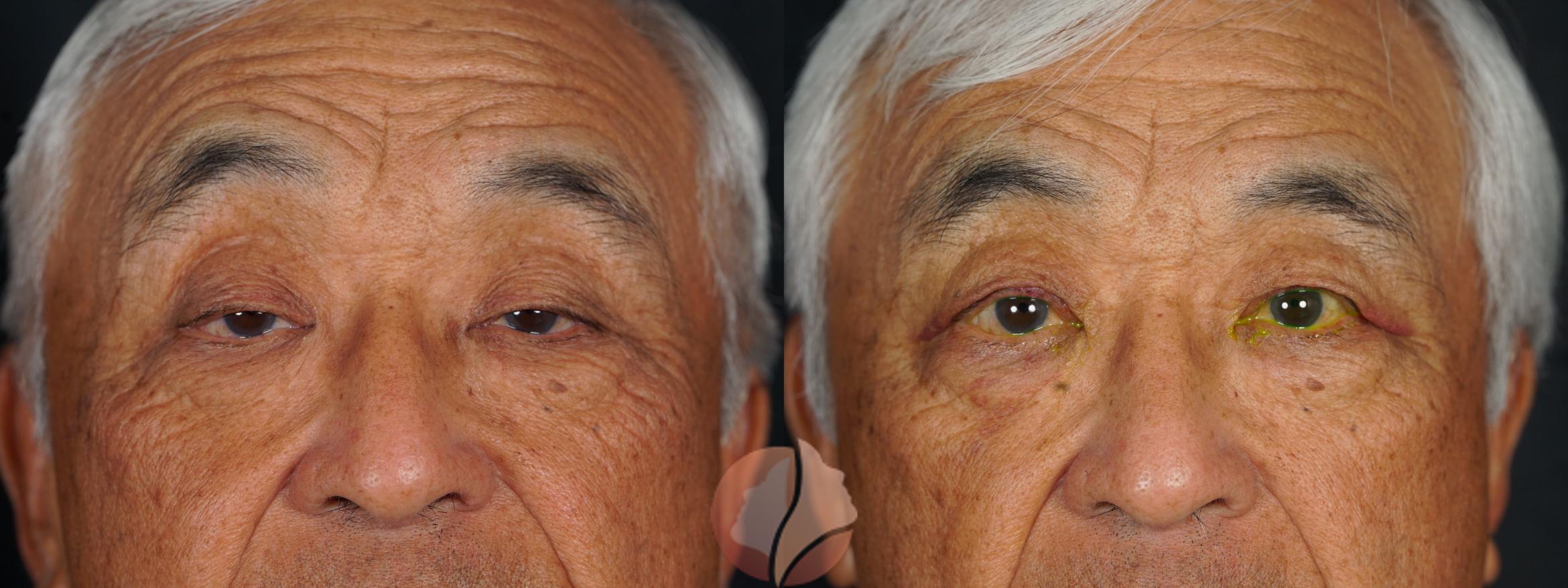 Before & After Ptosis - Men 70's Case 146 Front View in Saratoga, CA