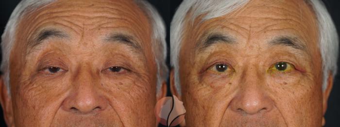 Before & After Ptosis - Men 70's Case 146 Front View in Saratoga, CA