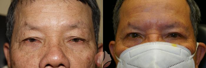 Before & After Ptosis - Men 70's Case 19 Front View in Saratoga, CA