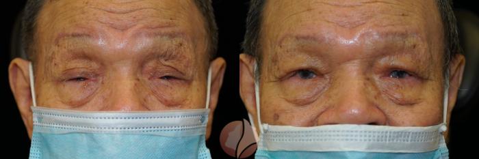 Before & After Ptosis - Men 70's Case 20 Front View in Saratoga, CA