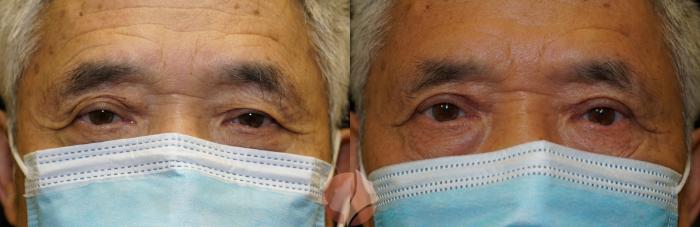 Before & After Ptosis - Men 70's Case 21 Front View in Saratoga, CA