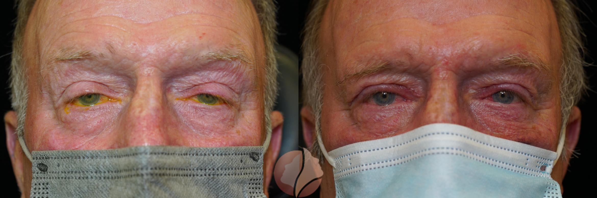 Before & After Ptosis - Men 70's Case 22 Front View in Saratoga, CA