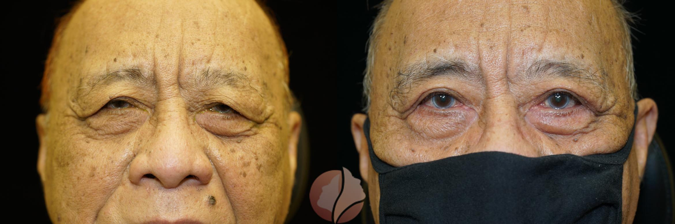 Before & After Ptosis - Men 70's Case 23 Front View in Saratoga, CA