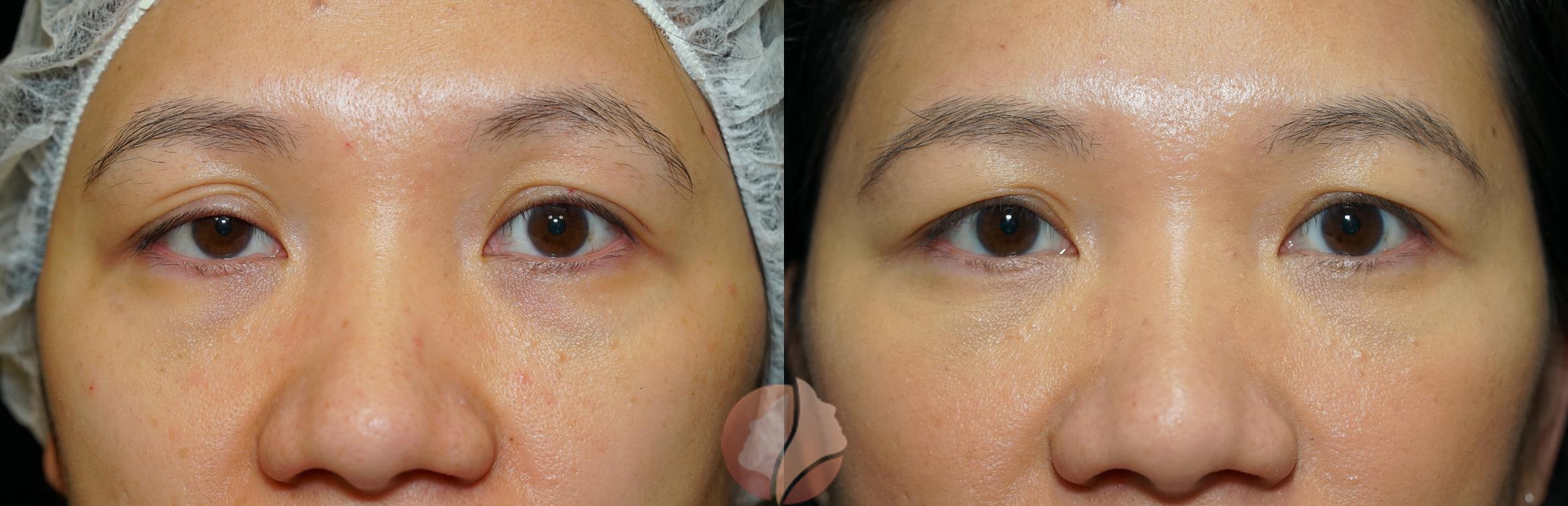 Before & After Ptosis - Women 40's Case 27 Front View in Saratoga, CA