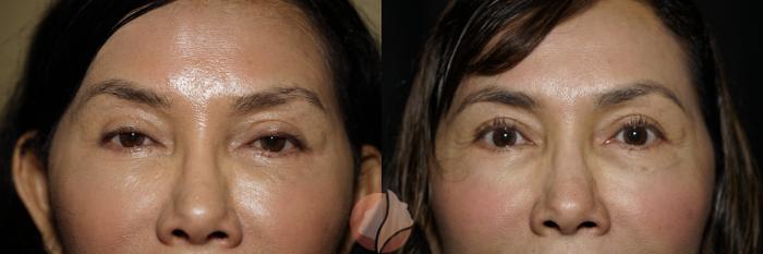 Before & After Ptosis - Women 50's Case 115 Front View in Saratoga, CA