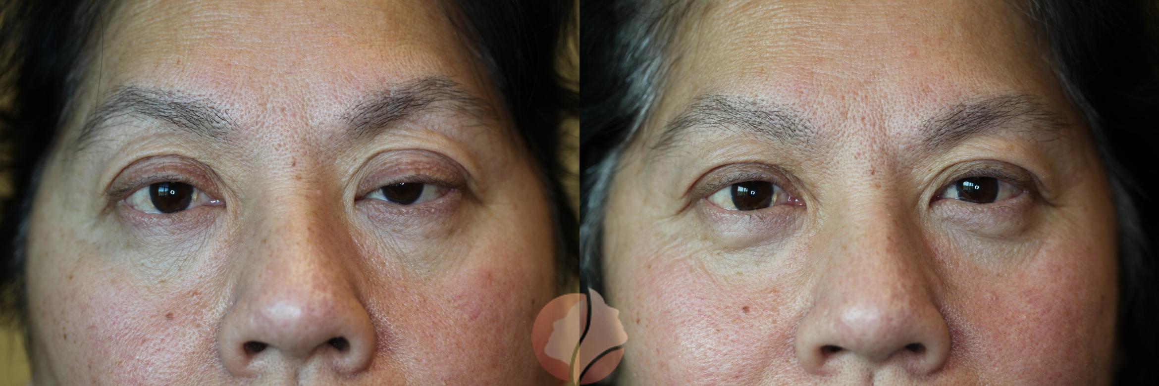 Before & After Ptosis - Women 50's Case 28 Front View in Saratoga, CA