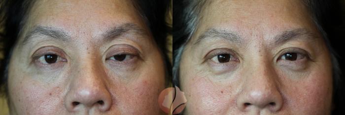 Before & After Ptosis - Women 50's Case 28 Front View in Saratoga, CA