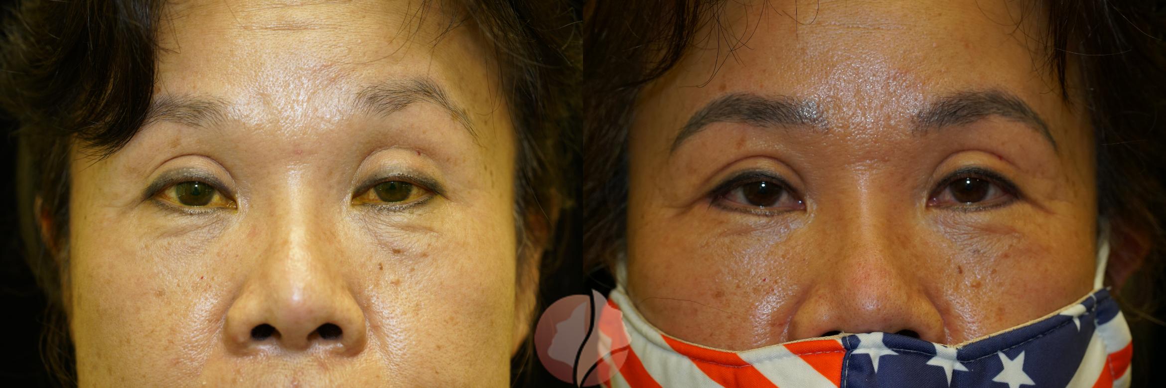 Before & After Ptosis - Women 50's Case 30 Front View in Saratoga, CA