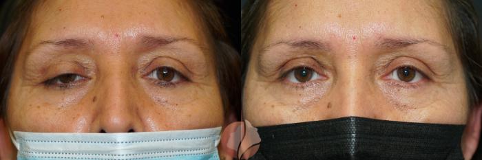 Before & After Ptosis - Women 50's Case 32 Front View in Saratoga, CA