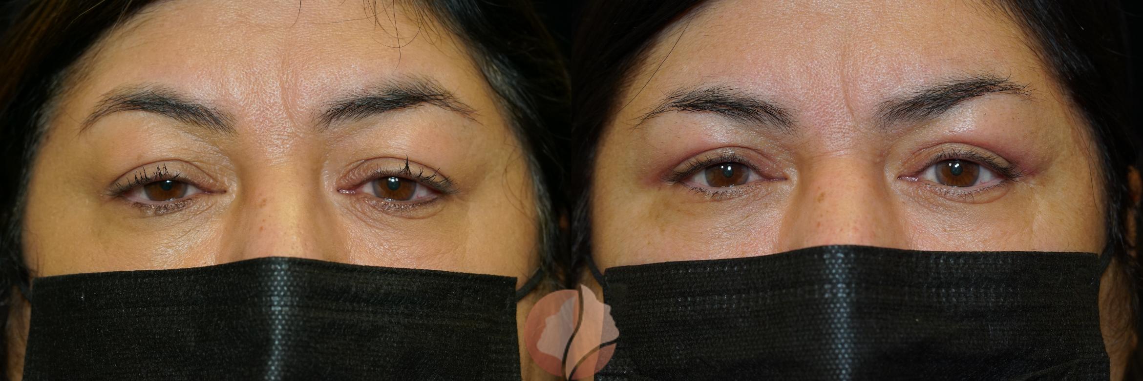 Before & After Ptosis - Women 50's Case 33 Front View in Saratoga, CA