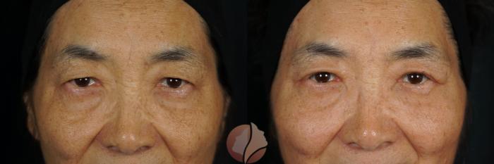Before & After Ptosis - Women 60's Case 148 Front View in Saratoga, CA