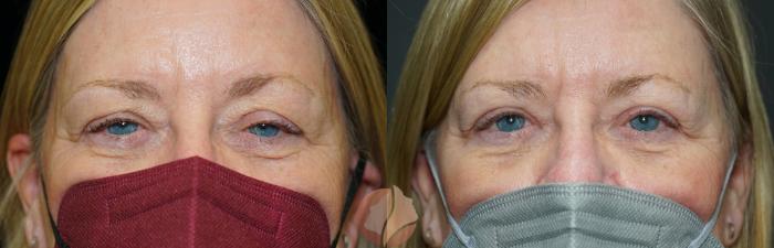 Before & After Ptosis - Women 60's Case 34 Front View in Saratoga, CA