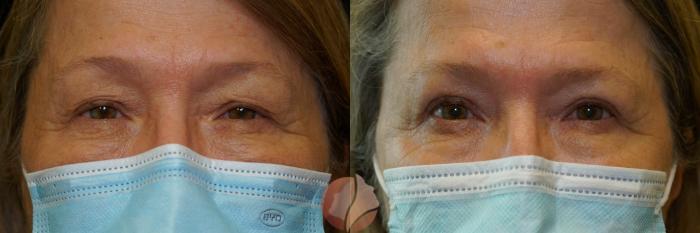 Before & After Ptosis - Women 60's Case 35 Front View in Saratoga, CA