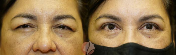 Before & After Ptosis - Women 60's Case 36 Front View in Saratoga, CA