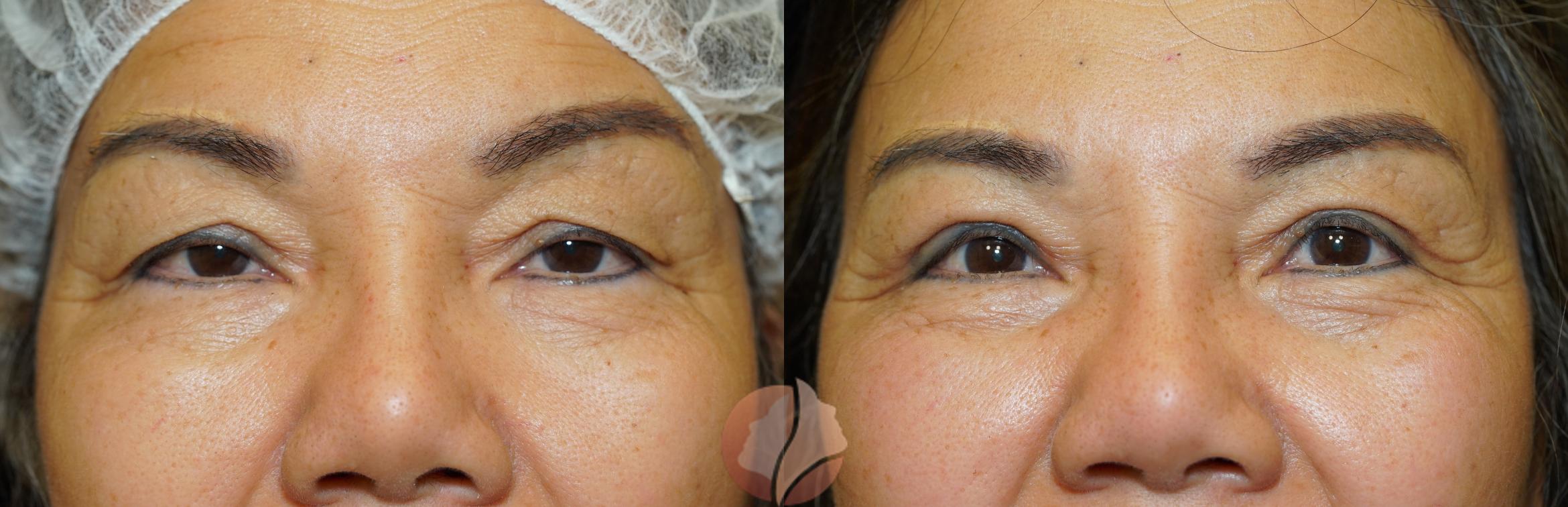 Before & After Ptosis - Women 60's Case 40 Front View in Saratoga, CA