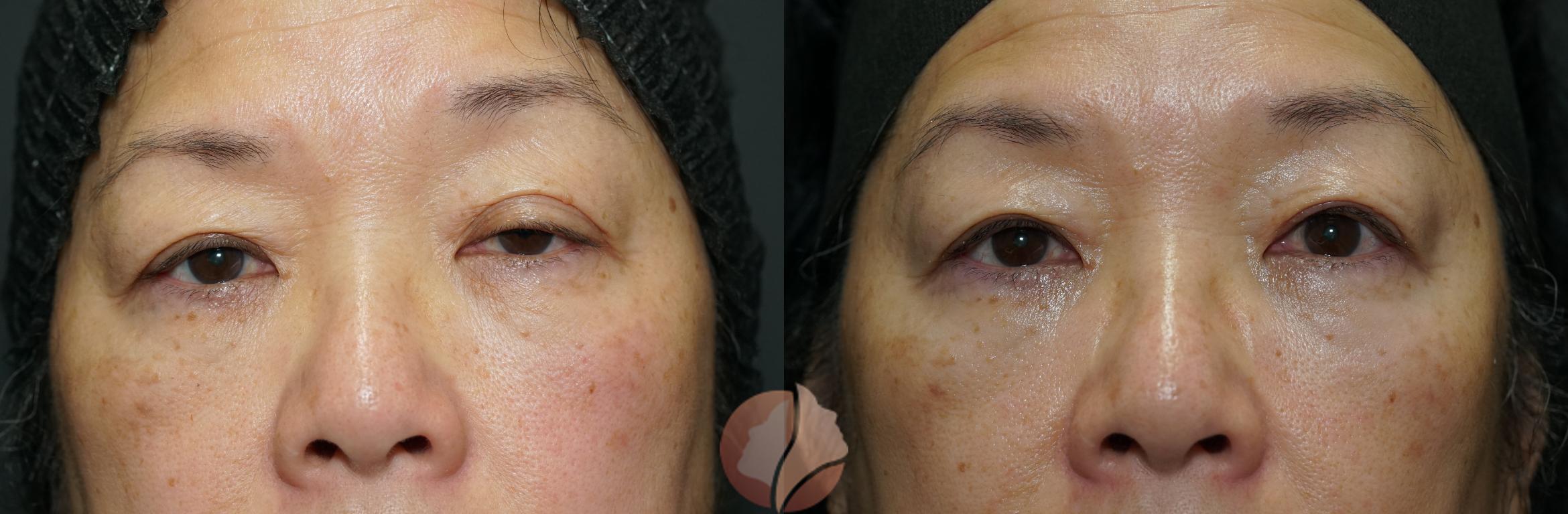 Before & After Ptosis - Women 60's Case 42 Front View in Saratoga, CA