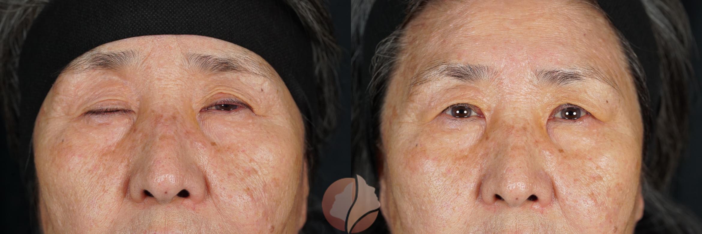 Before & After Ptosis - Women 70's Case 113 Front View in Saratoga, CA