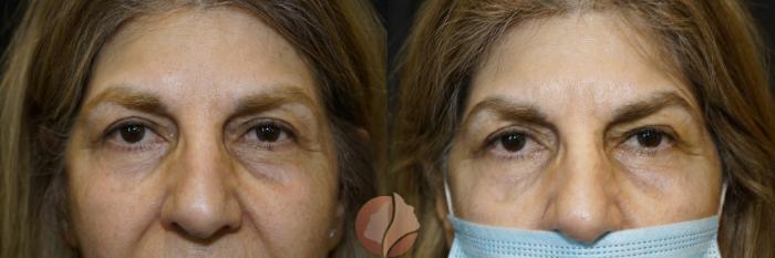 Before & After Ptosis - Women 70's Case 114 Front View in Saratoga, CA