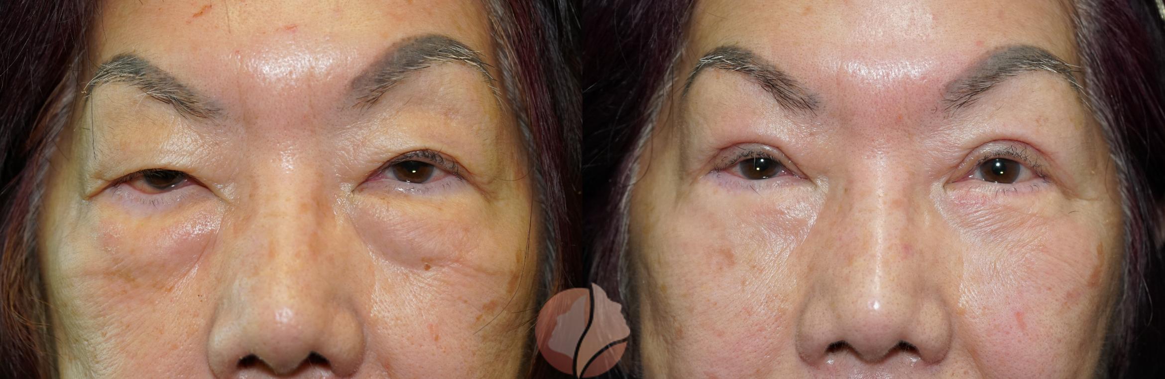 Before & After Ptosis - Women 70's Case 43 Front View in Saratoga, CA