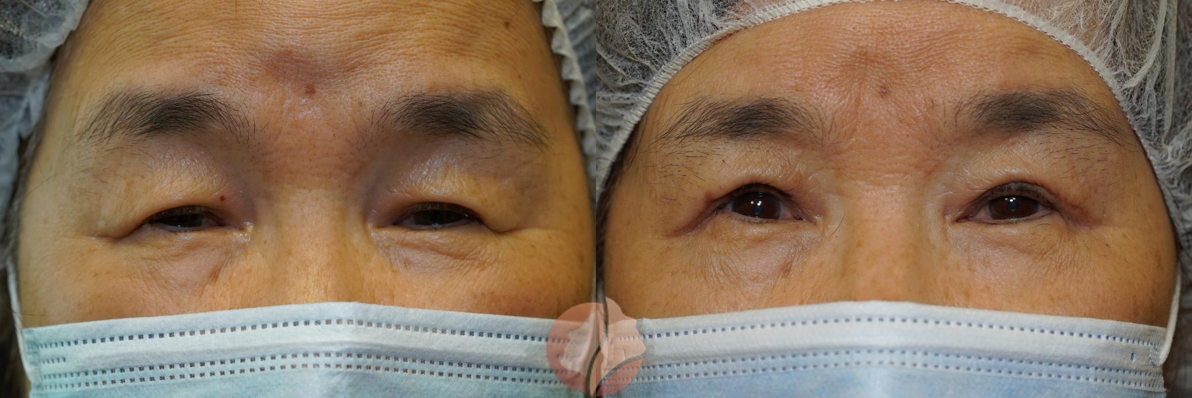 Before & After Ptosis - Women 70's Case 44 Front View in Saratoga, CA