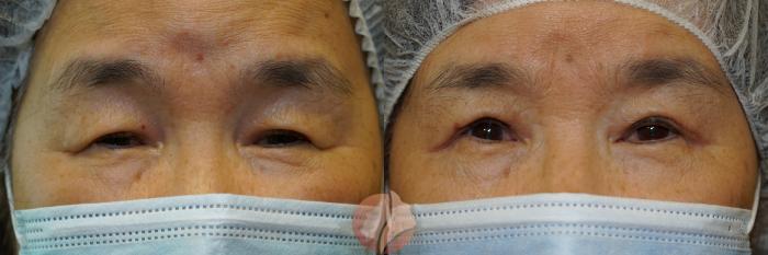 Before & After Ptosis - Women 70's Case 44 Front View in Saratoga, CA