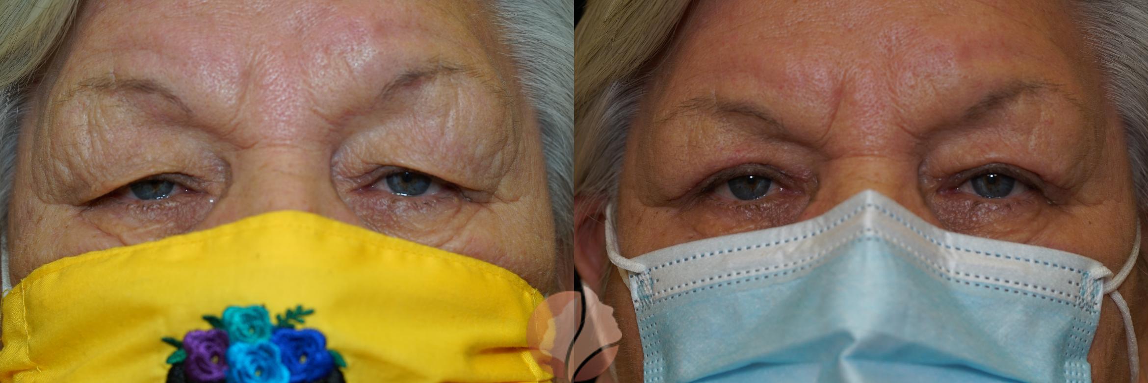 Before & After Ptosis - Women 70's Case 45 Front View in Saratoga, CA