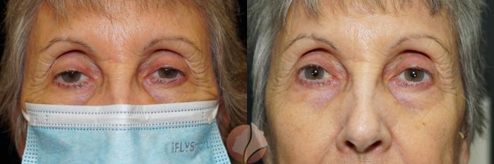 Before & After Ptosis - Women 70's Case 47 Front View in Saratoga, CA