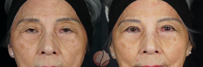 Ptosis Women - 80's Before and After Photo Gallery | Saratoga, CA ...