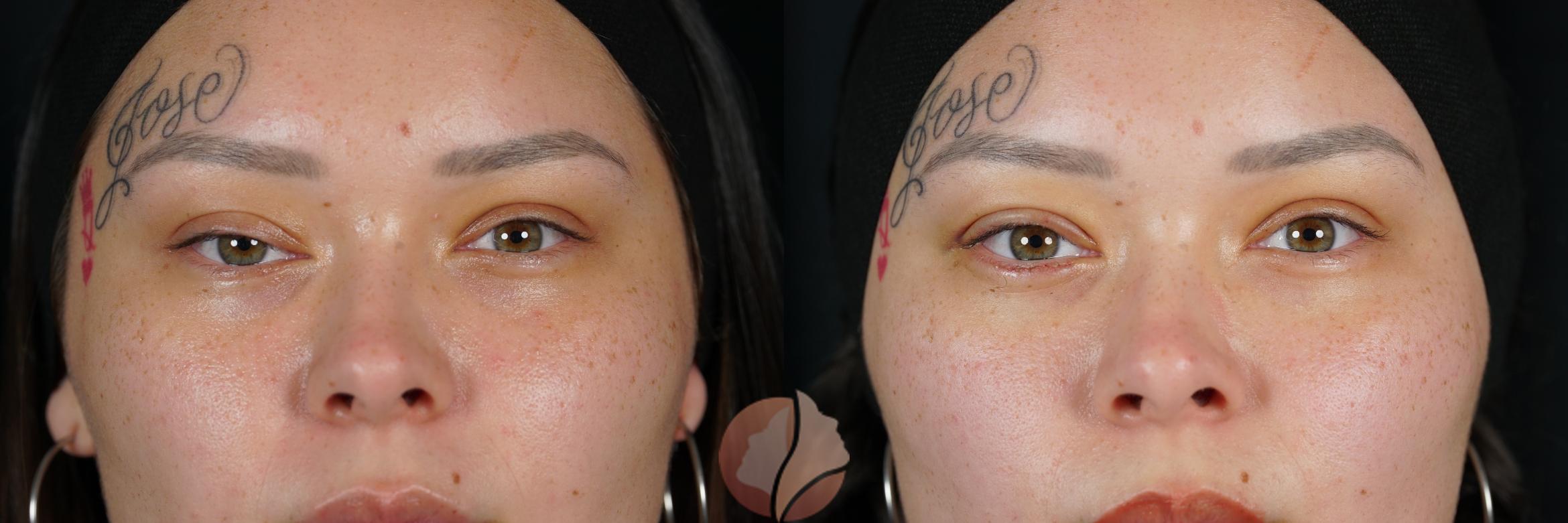 Before & After Ptosis Womens 20's Case 116 Front View in Saratoga, CA