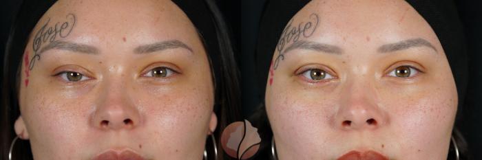 Before & After Ptosis Womens 20's Case 116 Front View in Saratoga, CA