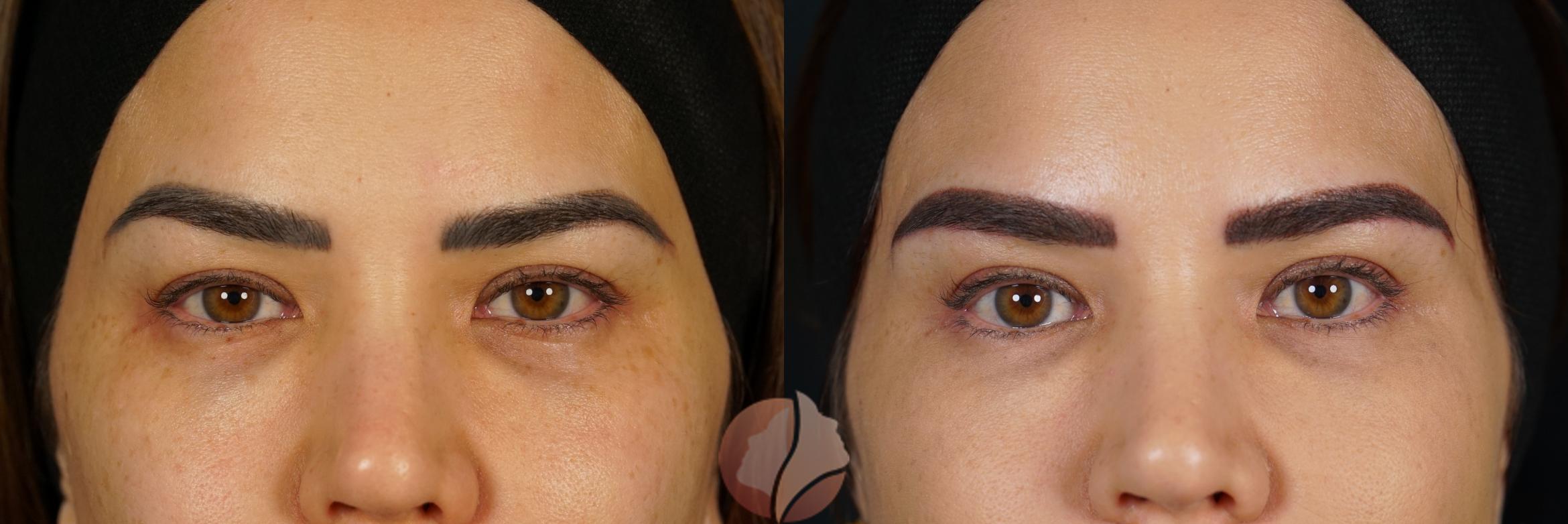 Bilateral Upper Lid