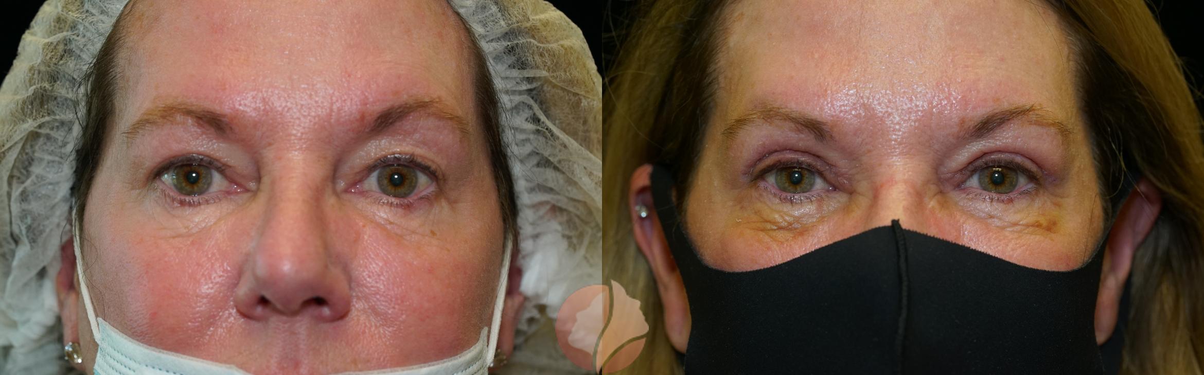 Before & After Upper Blepharoplasty Case 13 Front View in Saratoga, CA