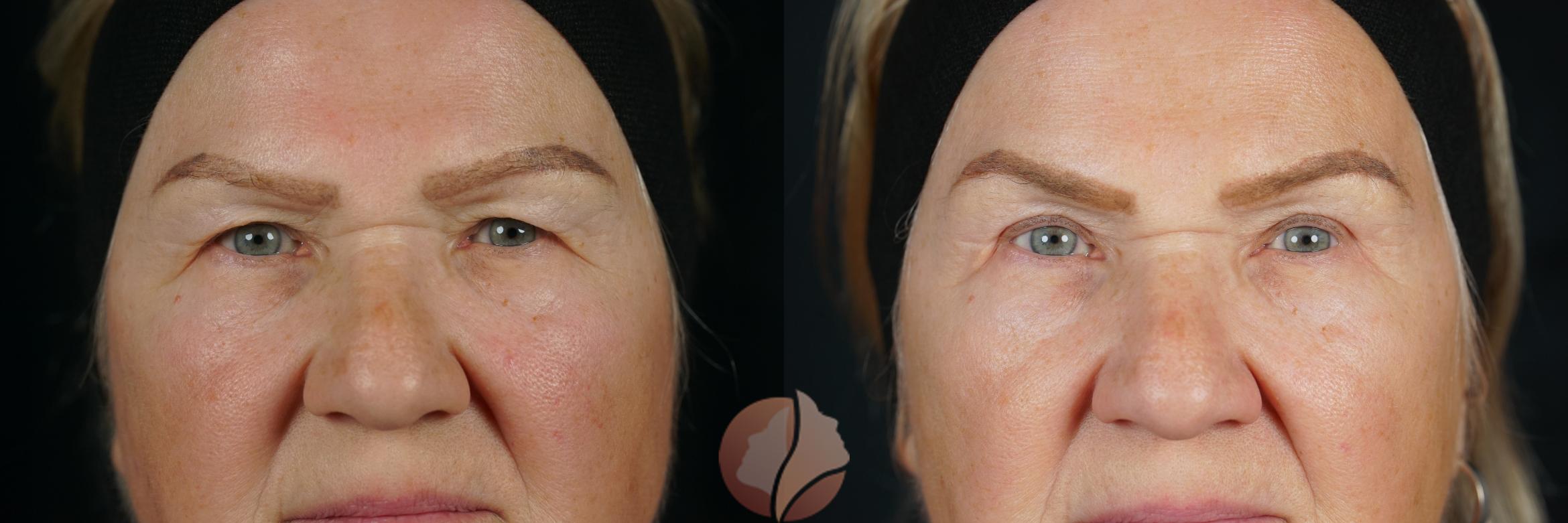 Bilateral upper lid blepharoplasty