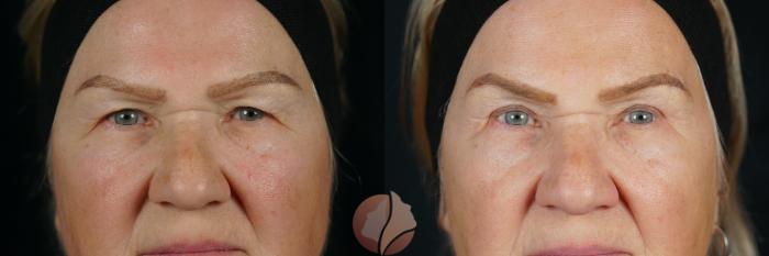 Bilateral upper lid blepharoplasty