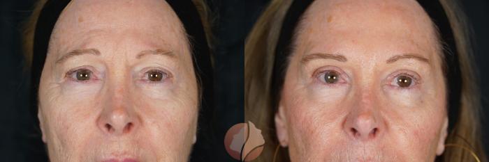 Before & After Upper Blepharoplasty Case 137 Front View in Saratoga, CA