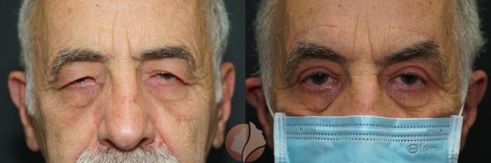 Before & After Brow Lift Case 138 Front View in Saratoga, CA