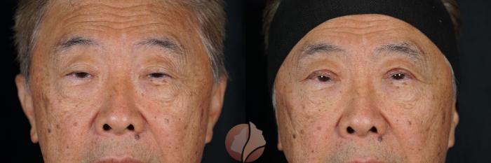 Before & After Upper Blepharoplasty Case 140 Front View in Saratoga, CA