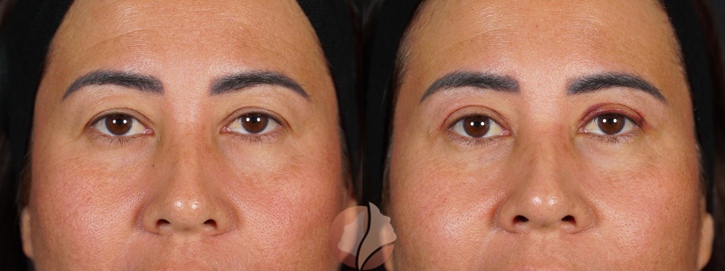 Before & After Upper Blepharoplasty Case 145 Front View in Saratoga, CA