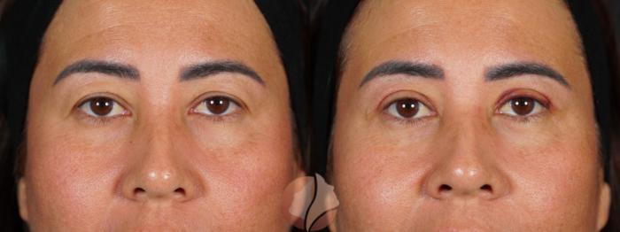 Before & After Upper Blepharoplasty Case 145 Front View in Saratoga, CA