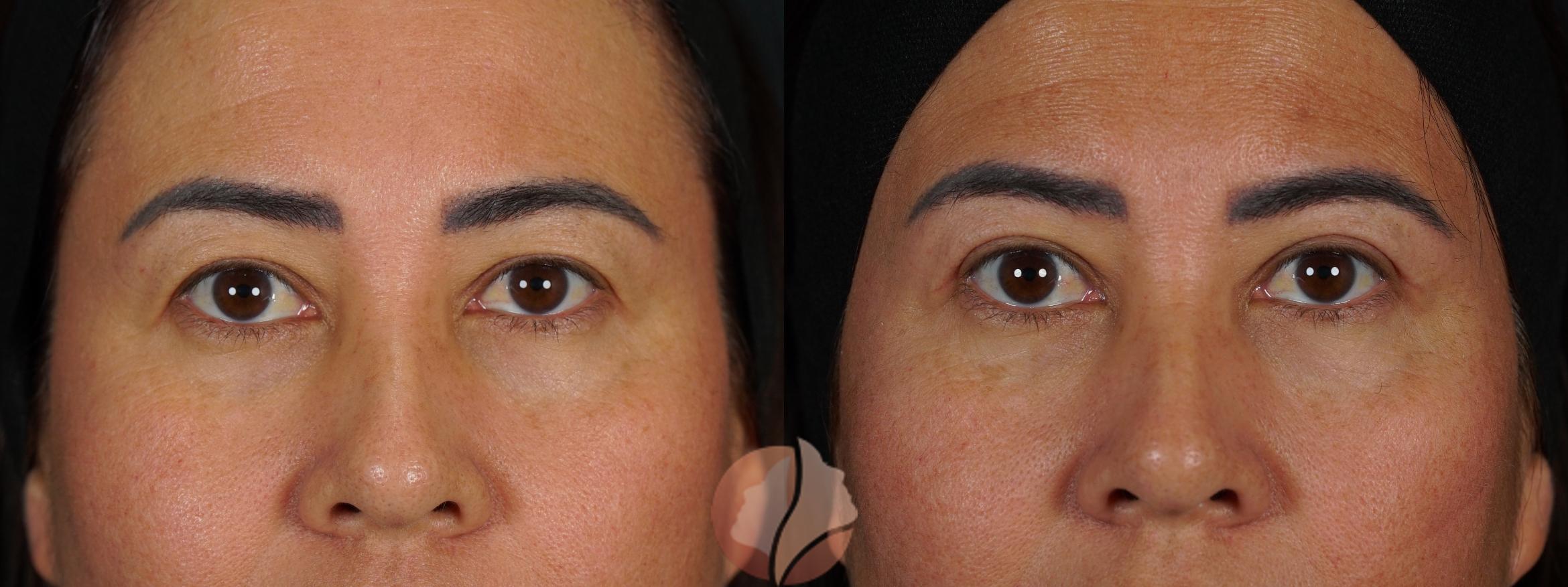 Before & After Upper Blepharoplasty Case 147 Front View in Saratoga, CA