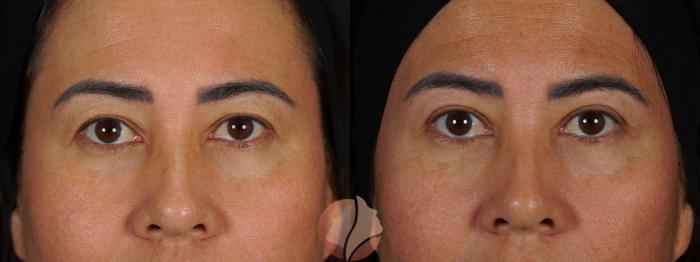 Before & After Upper Blepharoplasty Case 147 Front View in Saratoga, CA