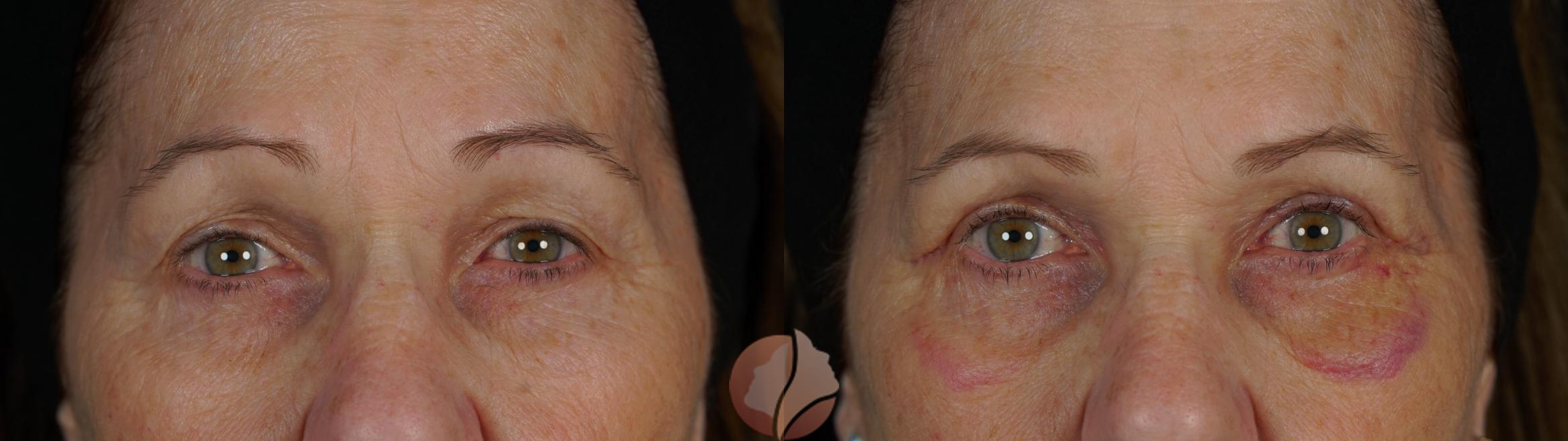 Before & After Upper Blepharoplasty Case 150 Front View in Saratoga, CA