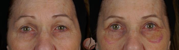 Before & After Ptosis - Women 60's Case 150 Front View in Saratoga, CA