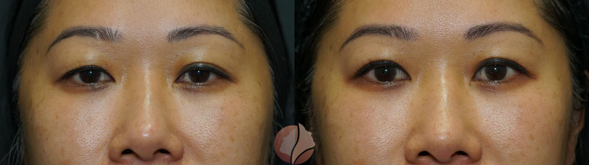 Before & After Upper Blepharoplasty Case 153 Front View in Saratoga, CA